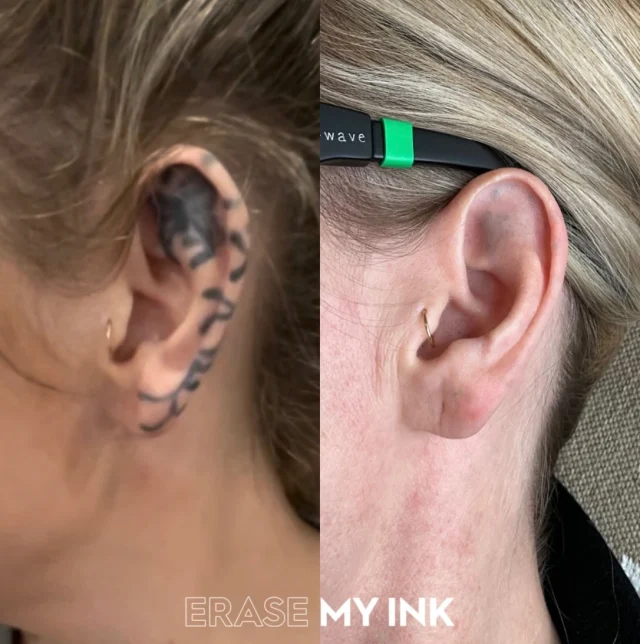 is redness after laser tattoo removal normal?